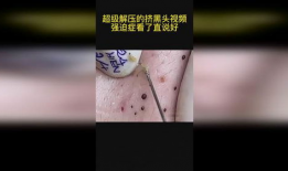 挤黑头的视频,告别毛孔堵塞烦恼